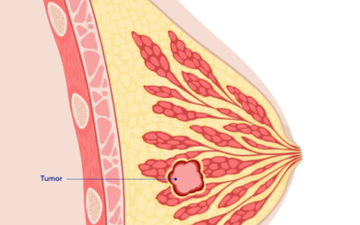 Breast Cancer – Early Signs And Symptoms
