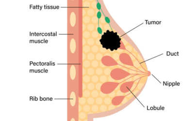 Breast Cancer – Early Signs And Symptoms