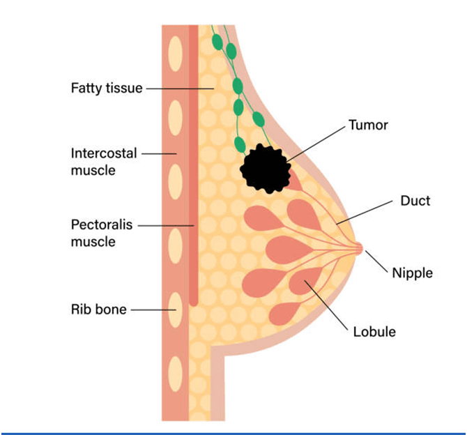 Breast Cancer – Early Signs And Symptoms