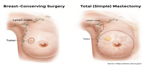 breast cancer surgery in mumbai