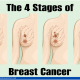 stages of breast cancer