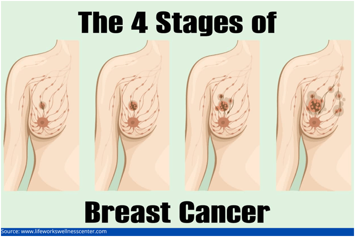 breast cancer stages
