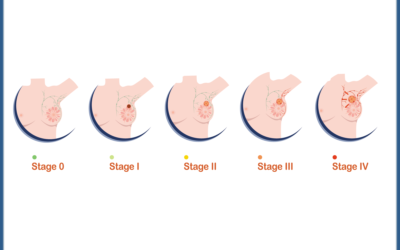 Stage 0 Breast Cancer: What You Need to Know
