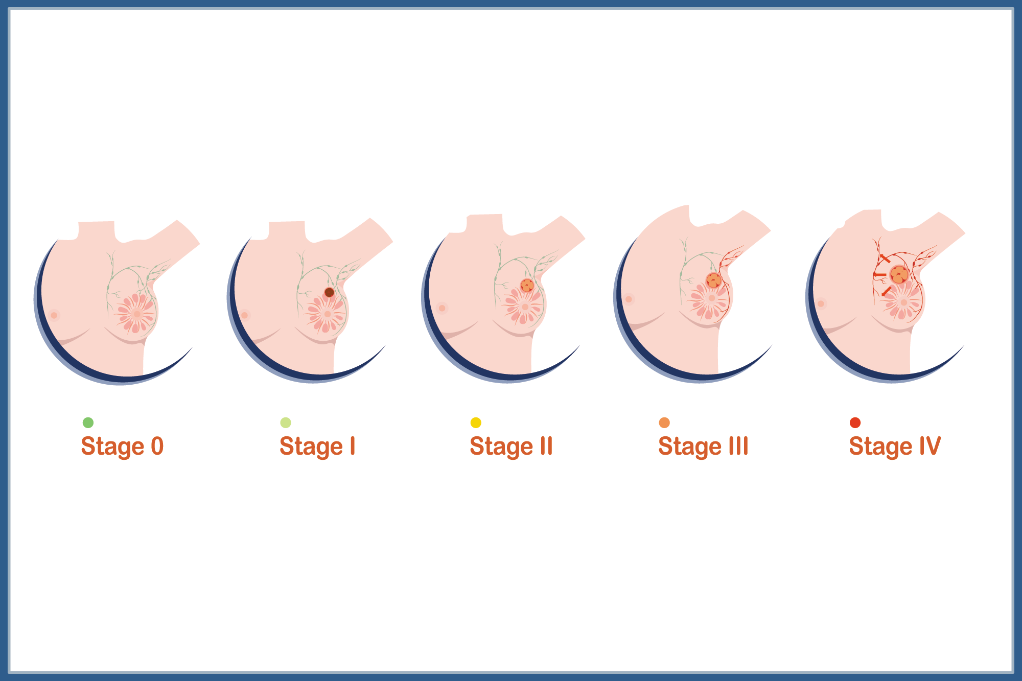 Stage 0 Breast Cancer:  What You Need to Know