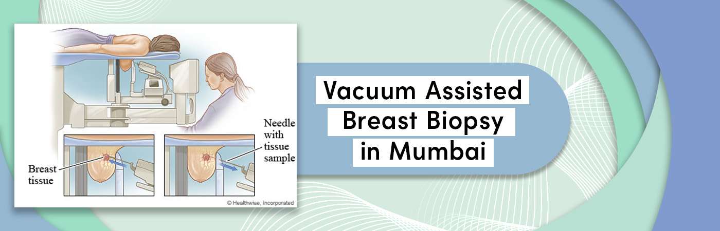 Vacuum Assisted Breast Biopsy in Mumbai - MRI Results