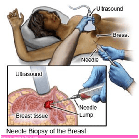 needle biopsy procedure