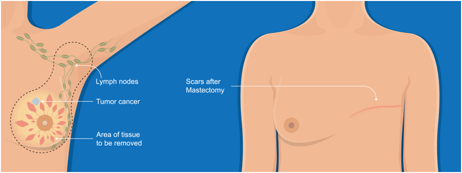 Preventive prophylactic mastectomy