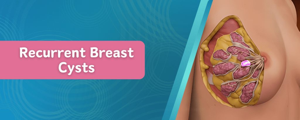 Recurrent Breast Cysts