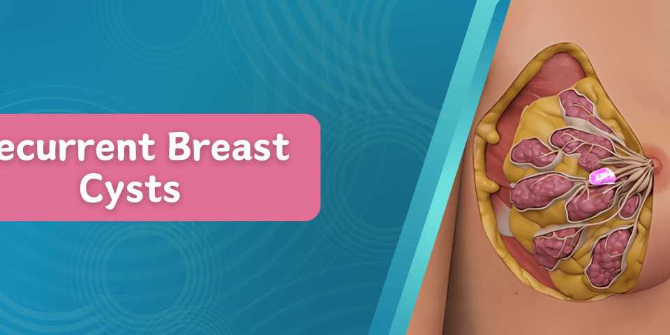 Recurrent Breast Cysts