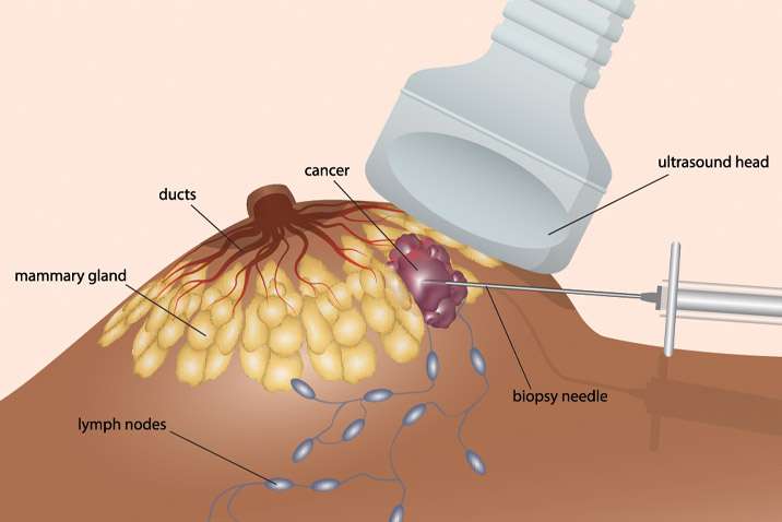 vacuum-assisted-breast-biopsy