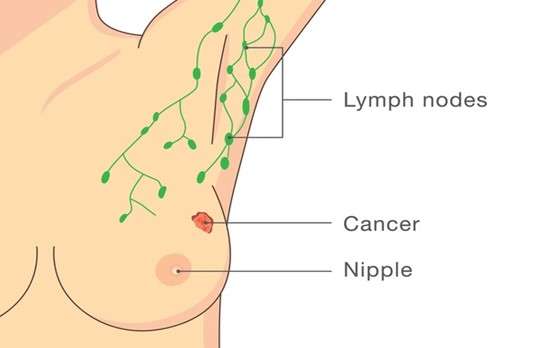 Biopsy-in-breast-cancer