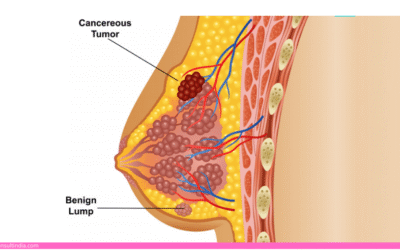 What Should I Expect During A Breast Biopsy?