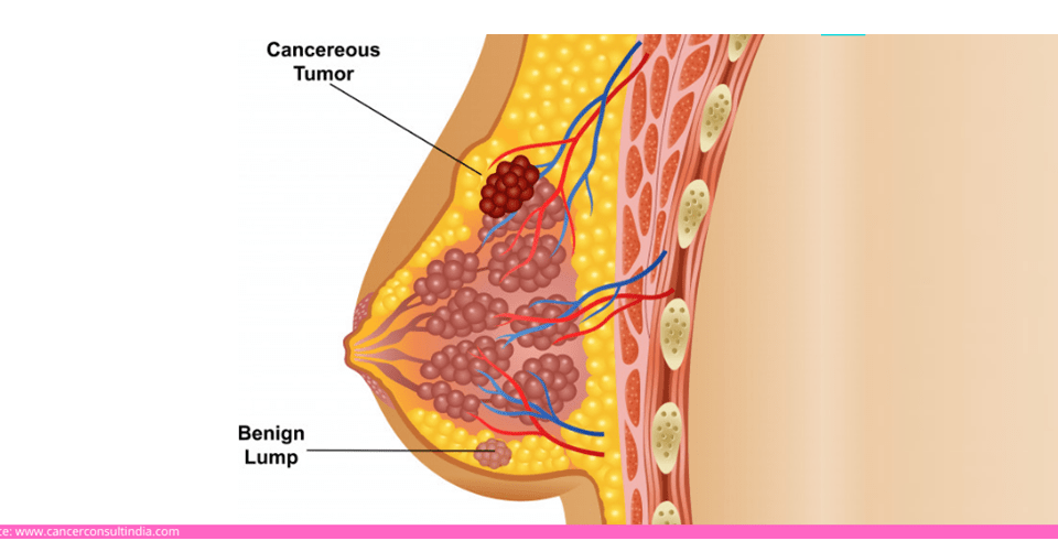 What Should I Expect During A Breast Biopsy?