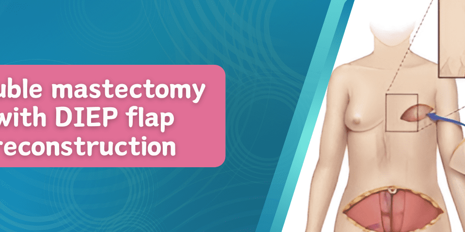 Double-Mastectomy-with-DIEP-Flap-Reconstruction-960x480