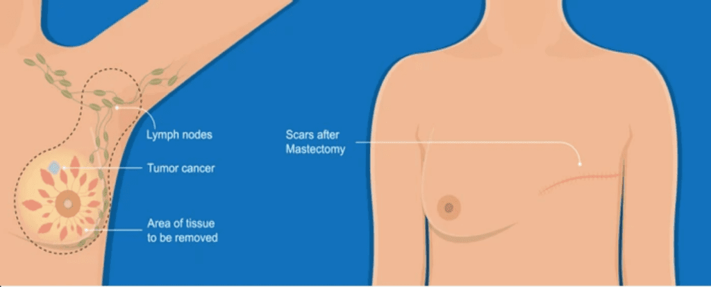 Breast Cancer 5-Year Survival Rate by Stage – Learn about influencing factors and ways to improve outcomes from a leading Breast Cancer Surgeon in Mumbai.