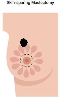 Understanding Nipple Sparing Mastectomy with Reconstruction