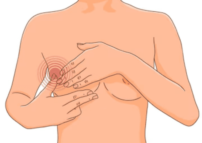 Possible Causes of Pain in Breast One Year After Lumpectomy Possible Causes of Pain in Breast One Year After Lumpectomy