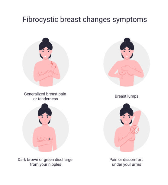 Causes of Several Cysts in Breast