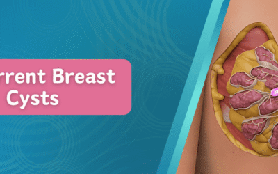 Recurrent Breast Cysts