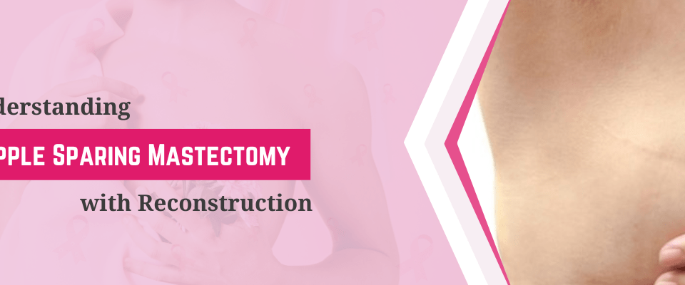 Understanding Nipple Sparing Mastectomy with Reconstruction