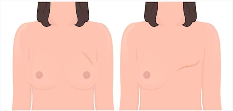 Understanding Post Mastectomy Pain