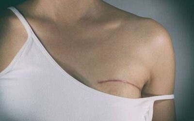 Triple-Negative Breast Cancer Recurrence After Surgery