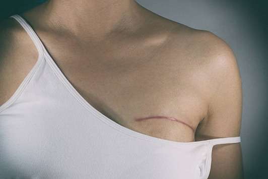 Triple-Negative Breast Cancer Recurrence After Surgery