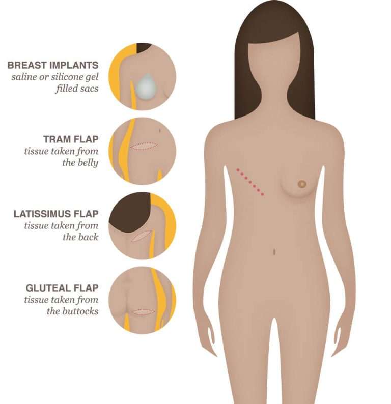 The list of reconstructive breast surgery after cancer includes:
