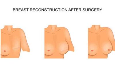 Breast Reconstruction After Cancer