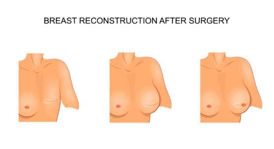 Breast Reconstruction After Cancer