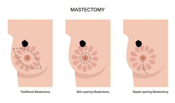 What Happens to Nerves During a Mastectomy?