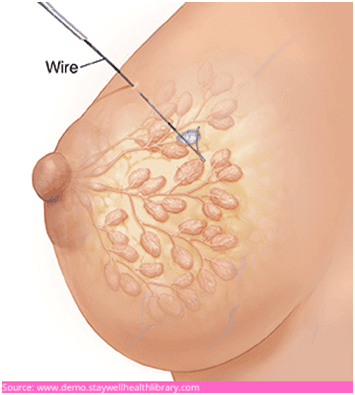 How is the preoperative localizing device inserted? How is the preoperative localizing device inserted?