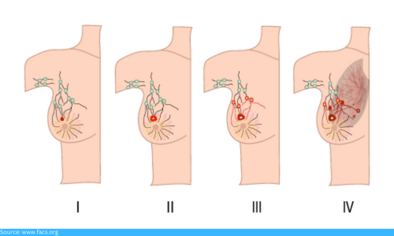 Survival Rate For Stage 3 Breast Cancer
