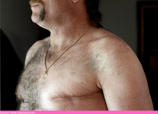 Myth #2: Breast cancer is only a woman’s disease