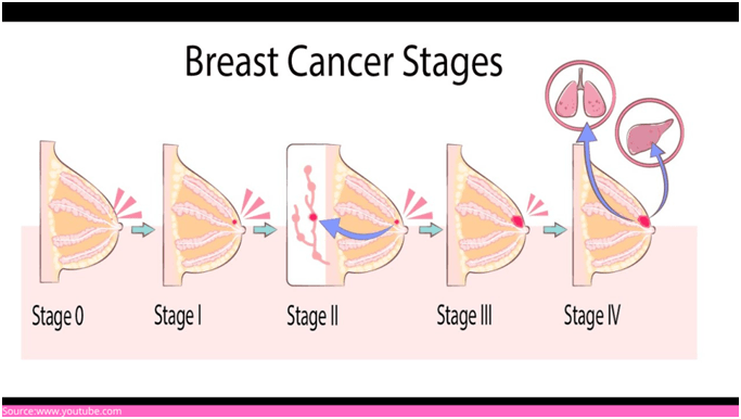 Breast cancer and the TNM staging system