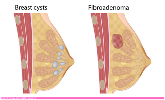 What is a breast lump?