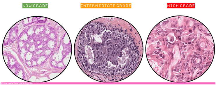 Grade of the cancer cells
