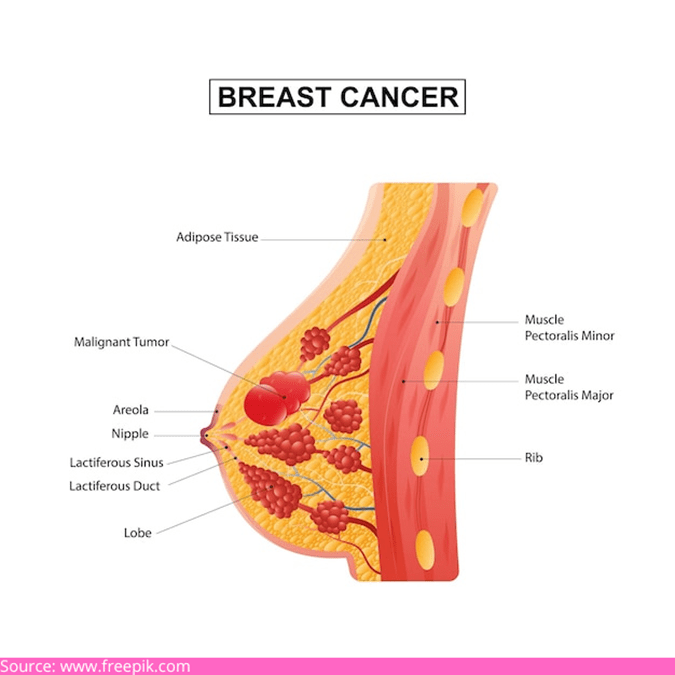 Tips To Recover Faster After Treatment For Breast Cancer | Dr. Garvit
