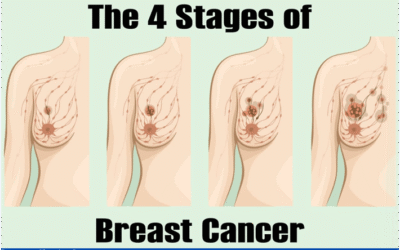 Stage 0 Breast Cancer:  What You Need to Know