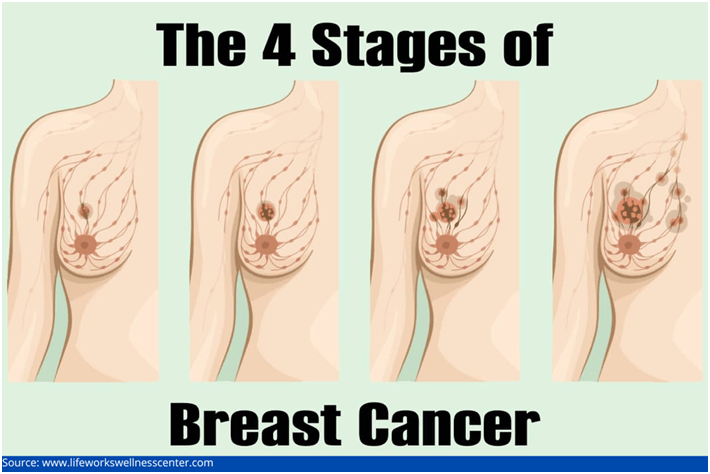 Stage 0 Breast Cancer:  What You Need to Know