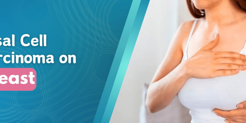 Basal Cell Carcinoma on Breast