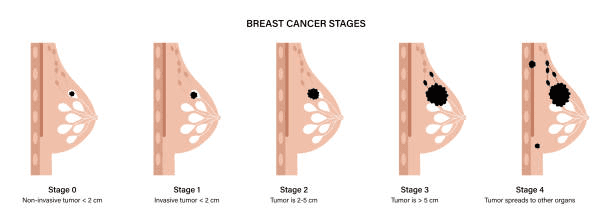 5-Year Survival Rate for Each Stage of Breast Cancer