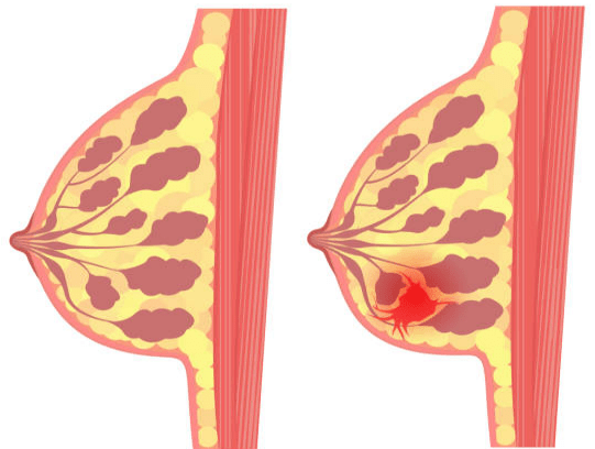 What Causes a New Lump After Lumpectomy?