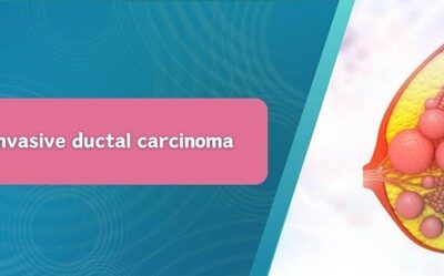 Stage 3 Invasive Ductal Carcinoma