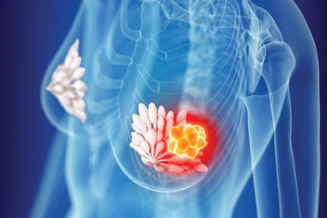 X-ray style illustration of a woman's breast with a highlighted orange tumor indicating breast cancer, near the tissue outline in red glow