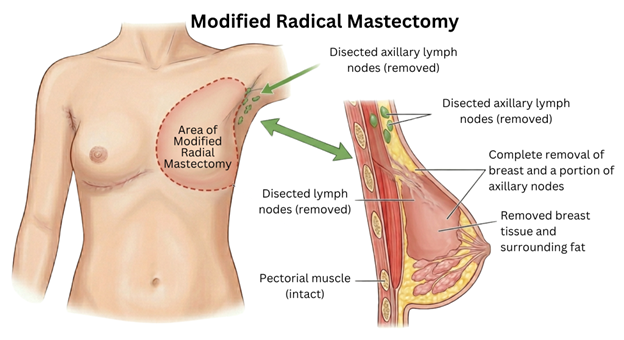 Cross-section of breast during lumpectomy: surgeon removes a pink tumor with healthy tissue safety margin; inset shows the removed tissue on a tray.