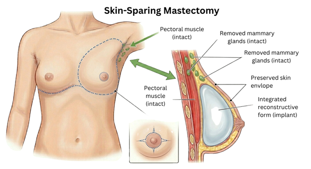 3 | Dr Garvit Cross-section of breast during lumpectomy: surgeon removes a pink tumor with healthy tissue safety margin; inset shows the removed tissue on a tray.