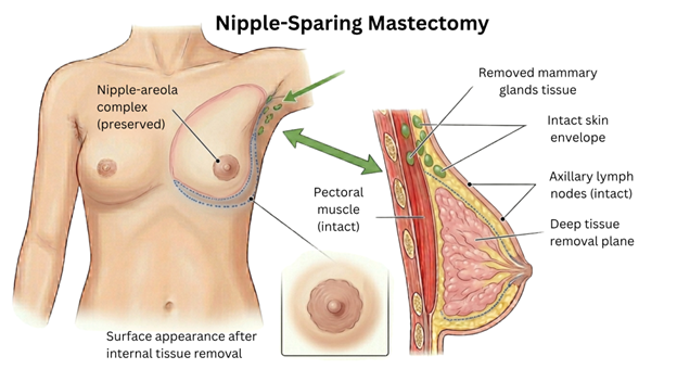 4 | Dr Garvit Diagram of a nipple-sparing mastectomy showing the nipple-areola complex preserved, intact pectoral muscle, and skin envelope with a cross-section of breast tissue and labeled structures.