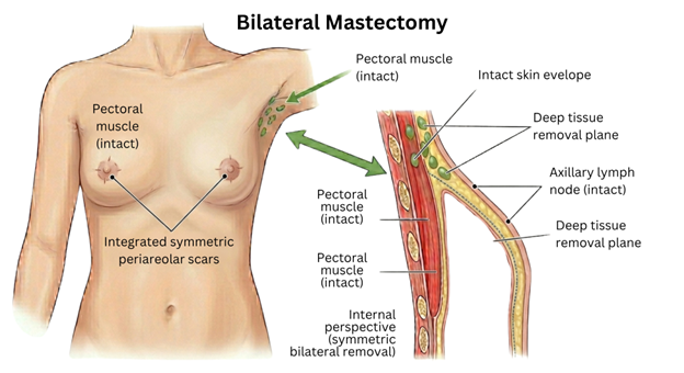 5 | Dr Garvit Diagram of a nipple-sparing mastectomy showing the nipple-areola complex preserved, intact pectoral muscle, and skin envelope with a cross-section of breast tissue and labeled structures.