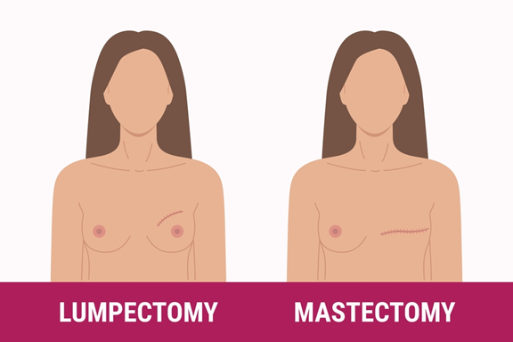 6 | Dr Garvit Side-by-side illustrations labeled Lumpectomy and Mastectomy, showing a natural breast on the left and a chest scar on the right.